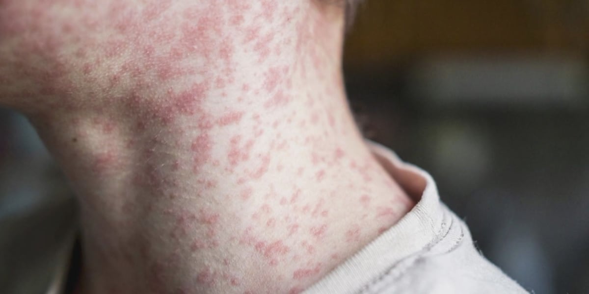 Minnesota measles outbreak reaches state’s second-highest in recent history