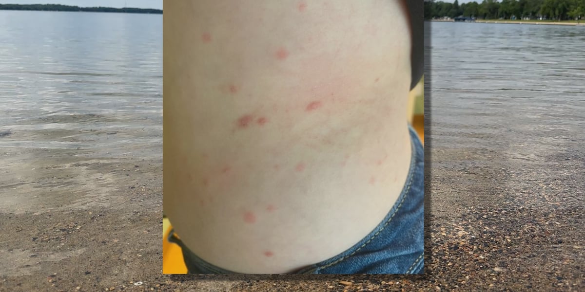 Freshwater Rash Swimmer’s Itch labeled health crisis in Lakes Country