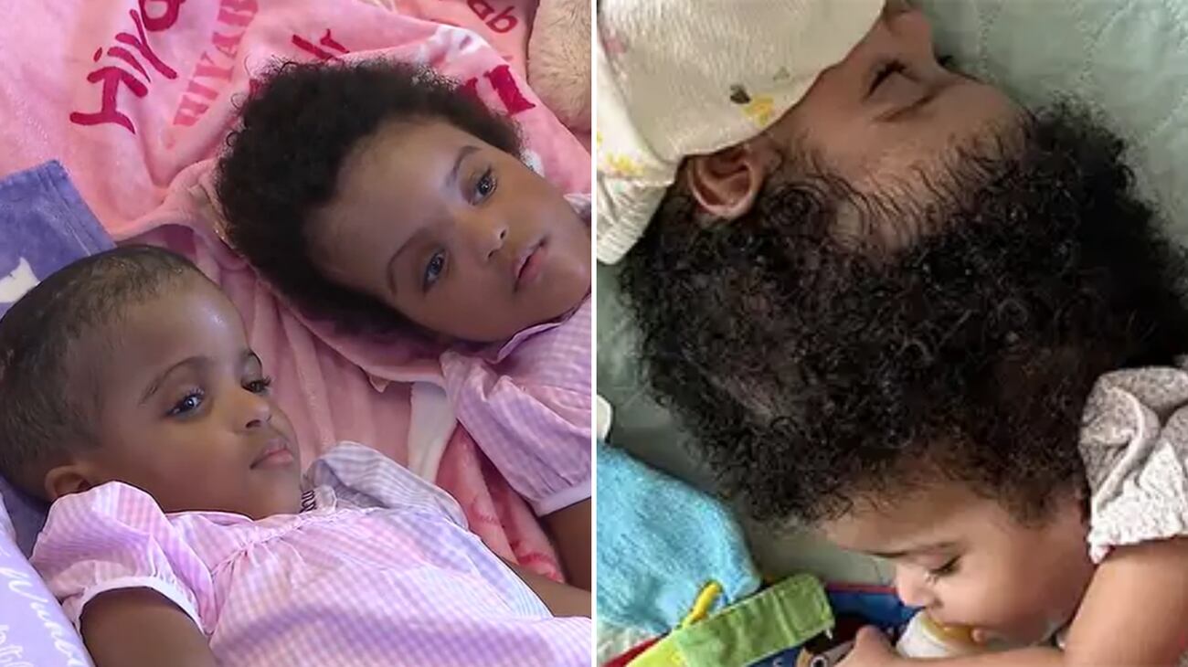 Conjoined twins Hiyab and Wuhbto were separated after a 24-hour surgery.